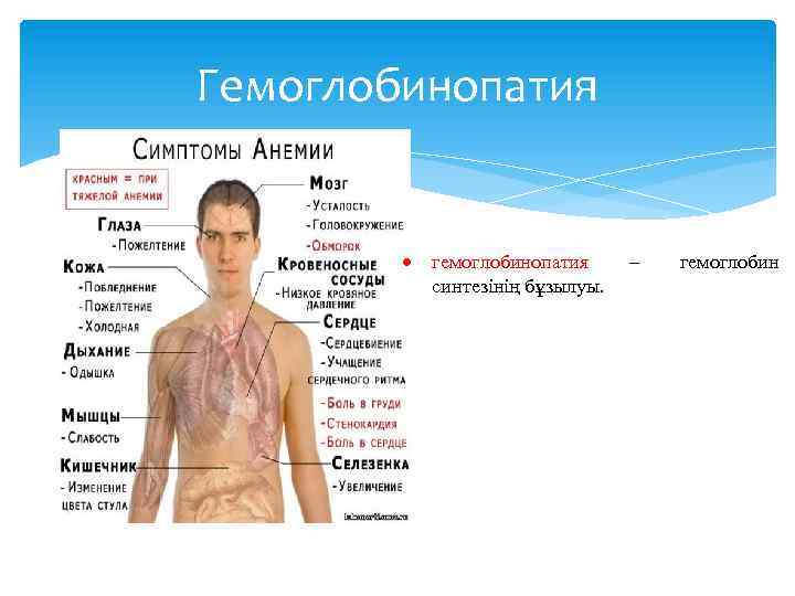 Острая анемия симптомы. Серповидноклеточная анемия клинические проявления. Серповидноклеточная анемия клинические признаки. Внешний вид человека с анемией. Гемоглобинопатии.