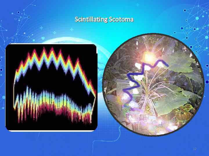 Scintillating Scotoma 12 