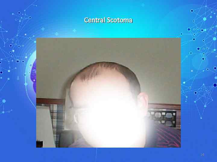 Central Scotoma 14 