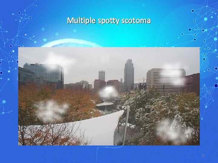 Multiple spotty scotoma 15 