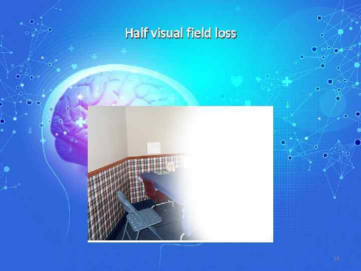 Half visual field loss 16 