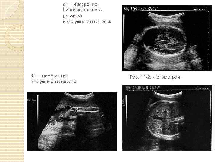 а — измерение бипариетального размера и окружности головы; б — измерение окружности живота; Рис.