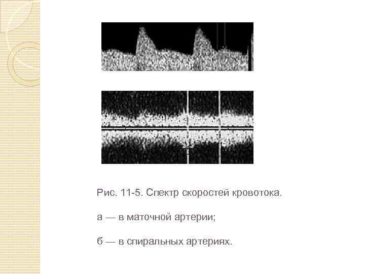 Рис. 11 -5. Спектр скоростей кровотока. а — в маточной артерии; б — в