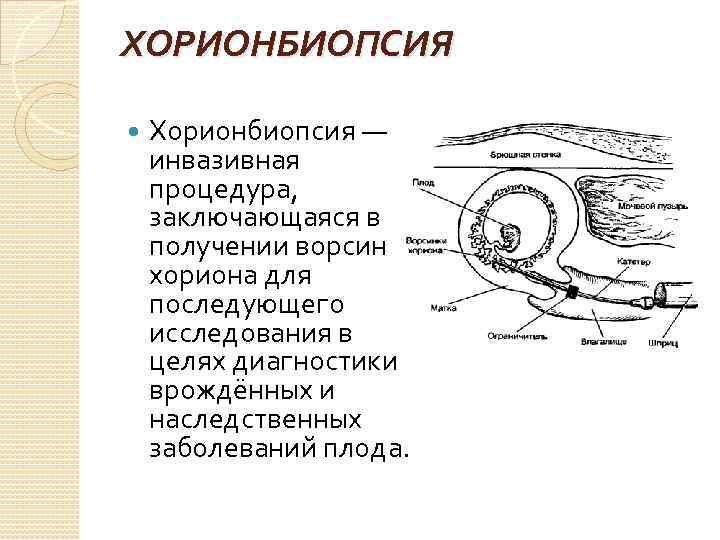 ХОРИОНБИОПСИЯ Хорионбиопсия — инвазивная процедура, заключающаяся в получении ворсин хориона для последующего исследования в