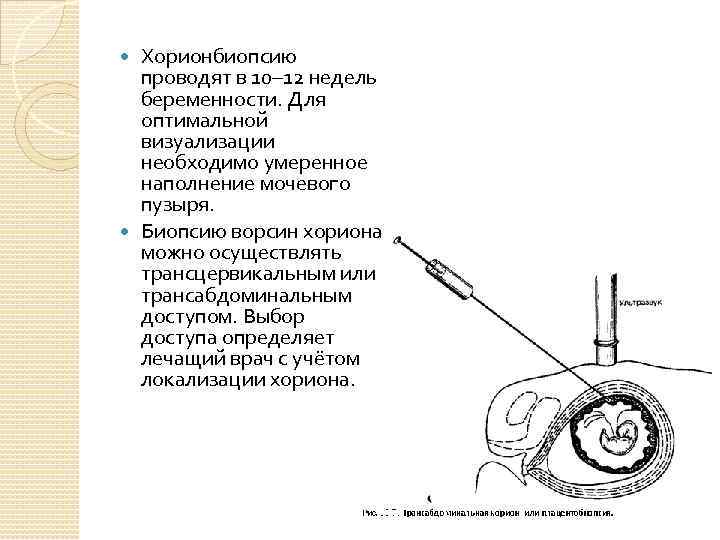 Хорионбиопсию проводят в 10– 12 недель беременности. Для оптимальной визуализации необходимо умеренное наполнение мочевого