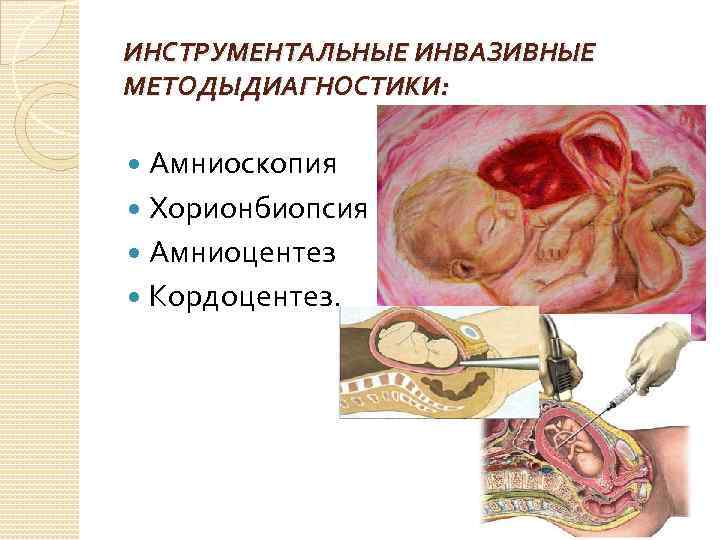 ИНСТРУМЕНТАЛЬНЫЕ ИНВАЗИВНЫЕ МЕТОДЫДИАГНОСТИКИ: Амниоскопия Хорионбиопсия Амниоцентез Кордоцентез. 