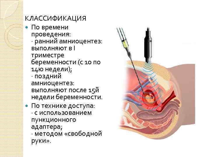 КЛАССИФИКАЦИЯ По времени проведения: · ранний амниоцентез: выполняют в I триместре беременности (с 10