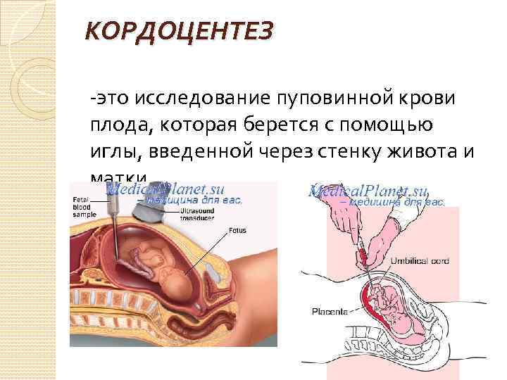 КОРДОЦЕНТЕЗ -это исследование пуповинной крови плода, которая берется с помощью иглы, введенной через стенку