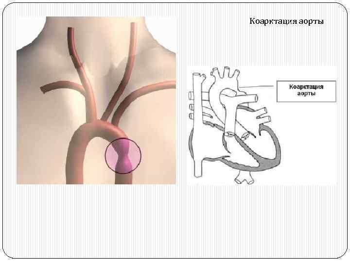 Коарктация аорты 