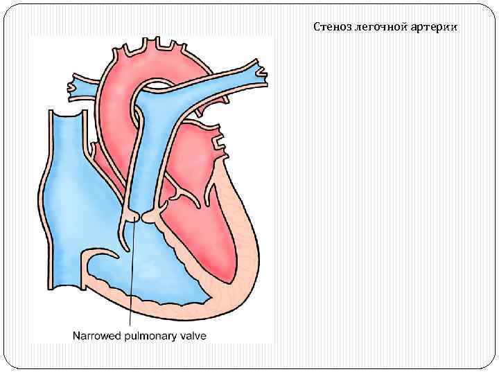 Стеноз легочной артерии 