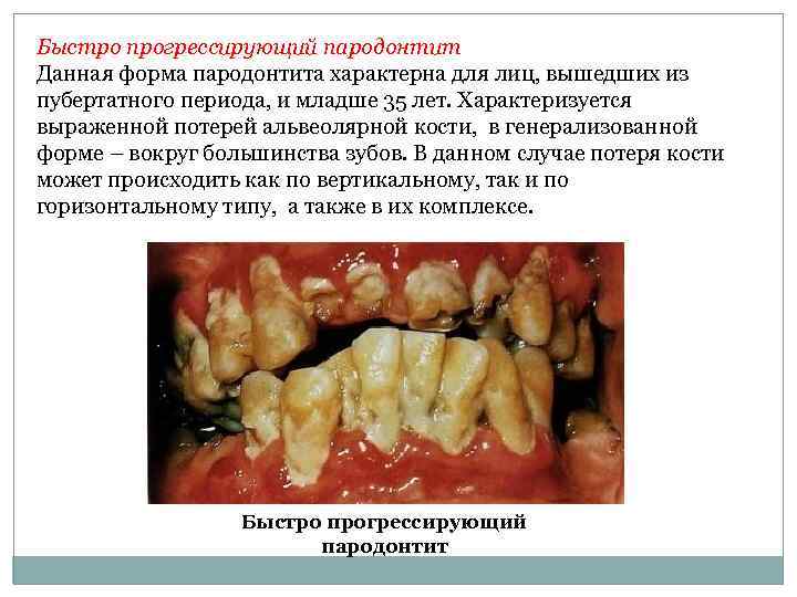 Быстро прогрессирующий пародонтит Данная форма пародонтита характерна для лиц, вышедших из пубертатного периода, и