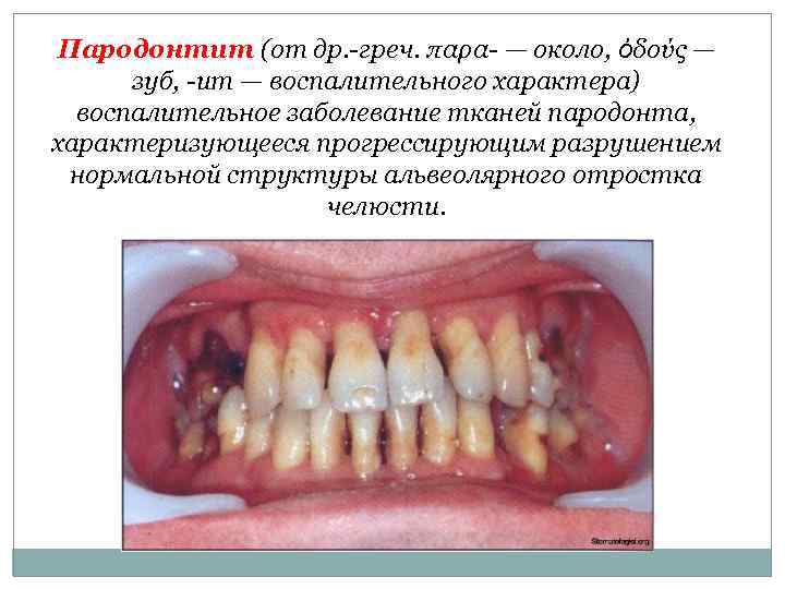 Пародонтит (от др. -греч. παρα- — около, ὀδούς — зуб, -ит — воспалительного характера)