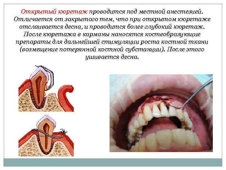 Открытый кюретаж проводится под местной анестезией. Отличается от закрытого тем, что при открытом кюретаже