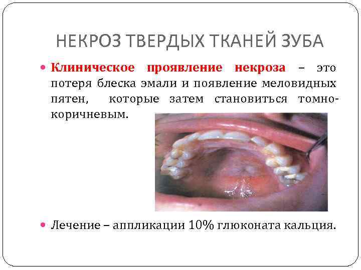 НЕКРОЗ ТВЕРДЫХ ТКАНЕЙ ЗУБА Клиническое проявление некроза – это потеря блеска эмали и появление