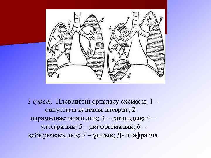 1 сурет. Плевриттің орналасу схемасы: 1 – синустағы қалталы плеврит; 2 – парамедиастинальдық; 3