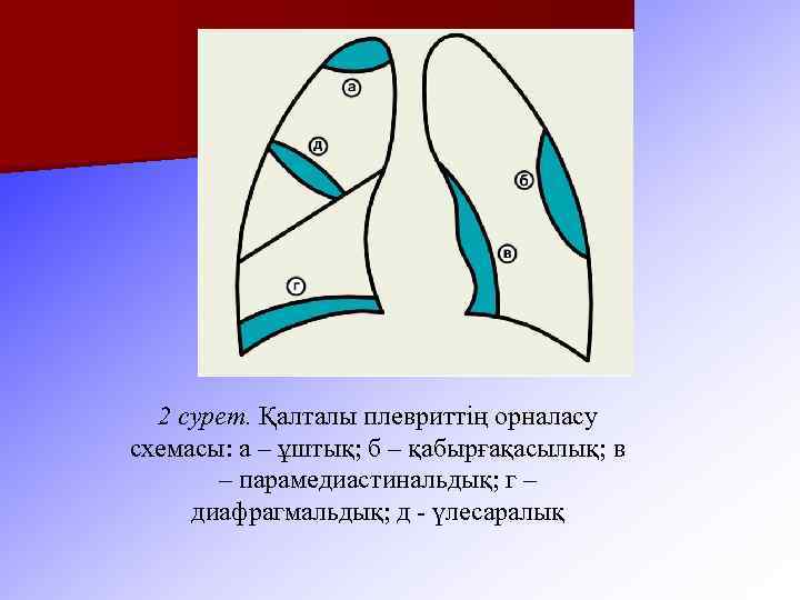 2 сурет. Қалталы плевриттің орналасу схемасы: а – ұштық; б – қабырғақасылық; в –