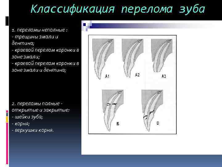 Классификация перелома зуба 1. переломы неполные : - трещины эмали и дентина; - краевой