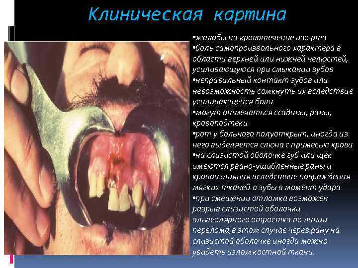 Клиническая картина • жалобы на кровотечение изо рта • боль самопроизвольного характера в области