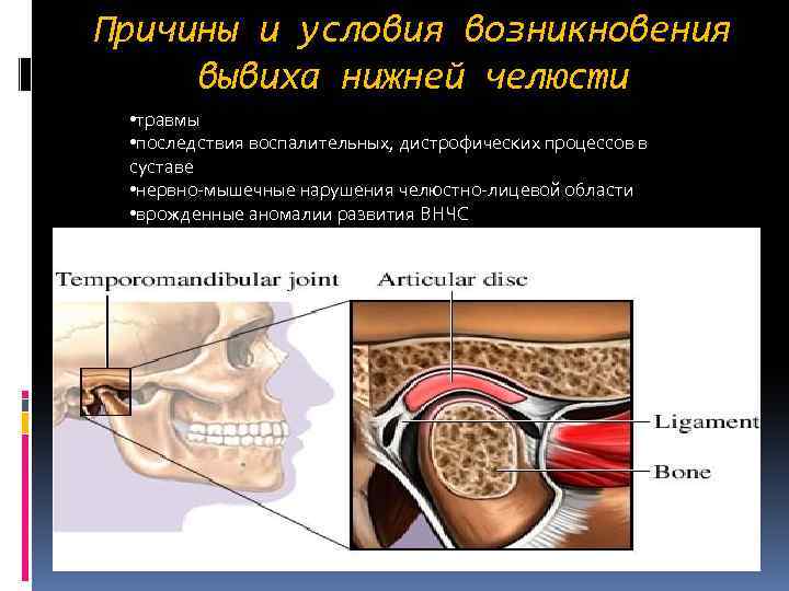 Причины и условия возникновения вывиха нижней челюсти • травмы • последствия воспалительных, дистрофических процессов