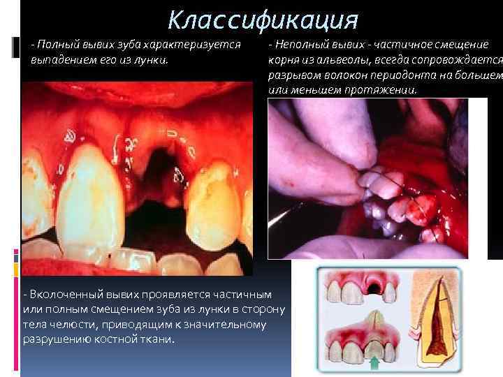 Классификация - Полный вывих зуба характеризуется выпадением его из лунки. - Неполный вывих -