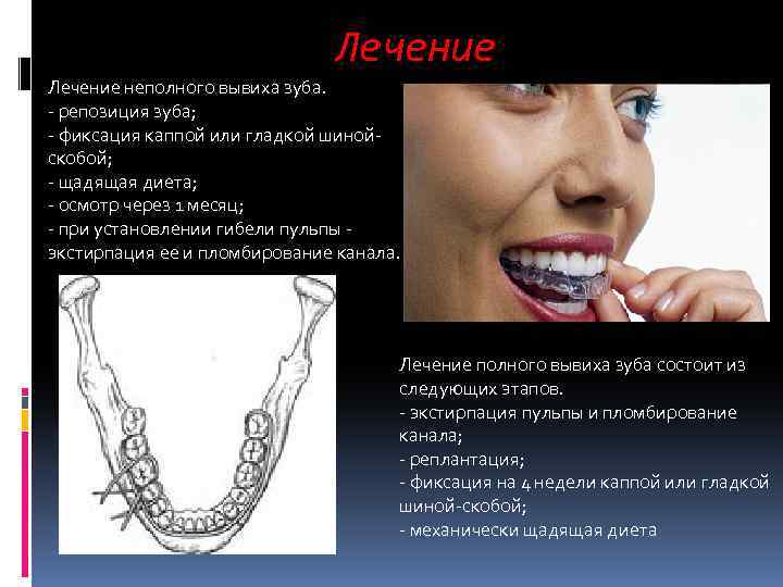 Лечение неполного вывиха зуба. - репозиция зуба; - фиксация каппой или гладкой шинойскобой; -