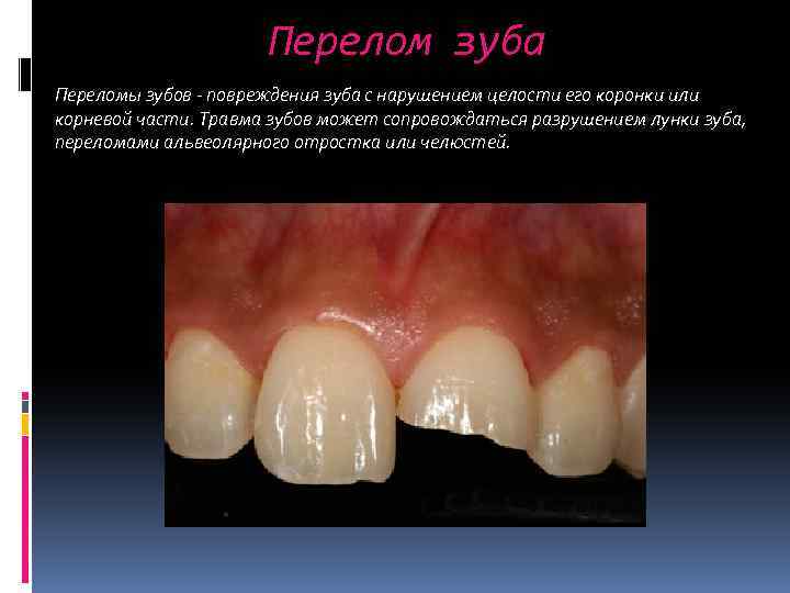 Перелом зуба Переломы зубов - повреждения зуба с нарушением целости его коронки или корневой