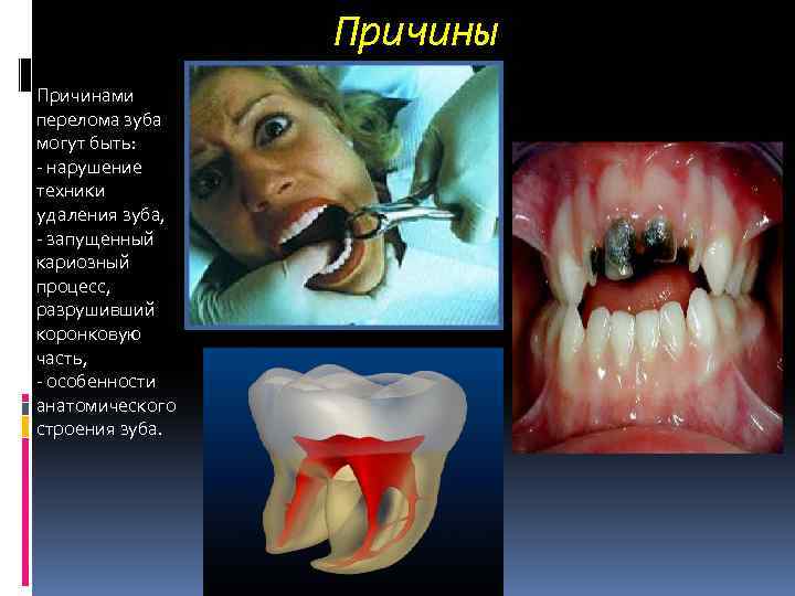 Причины Причинами перелома зуба могут быть: - нарушение техники удаления зуба, - запущенный кариозный