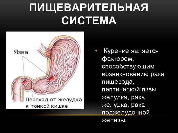 ПИЩЕВАРИТЕЛЬНАЯ СИСТЕМА • Курение является фактором, способствующим возникновению рака пищевода, пептической язвы желудка, рака