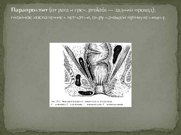 Парапроктит (от para и греч. proktós — задний проход), гнойное воспаление клетчатки, окружающей прямую