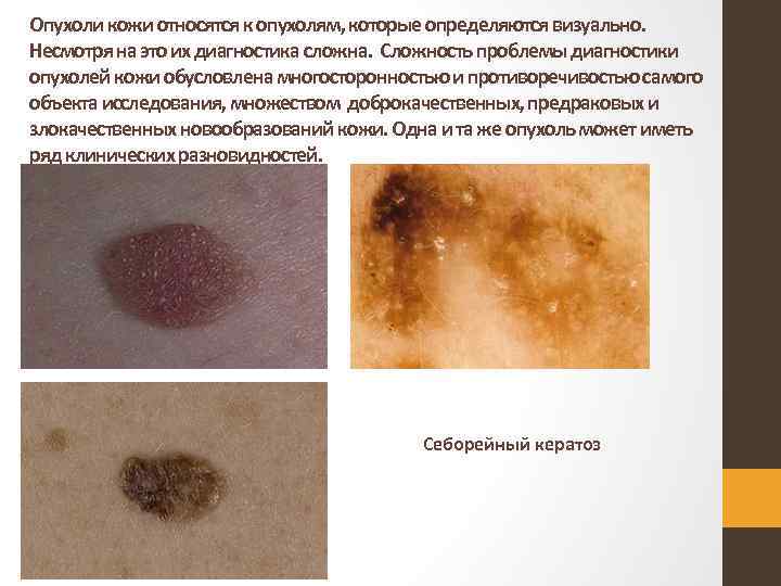 Опухоли кожи относятся к опухолям, которые определяются визуально. Несмотря на это их диагностика сложна.