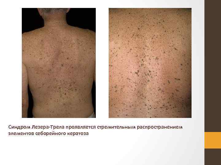 Синдром Лезера Трела проявляется стремительным распространением элементов себорейного кератоза 