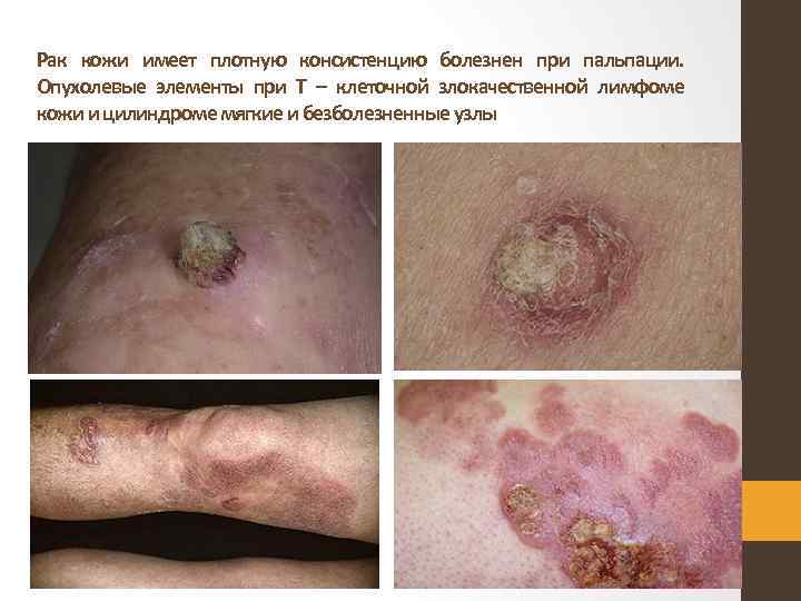 Рак кожи имеет плотную консистенцию болезнен при пальпации. Опухолевые элементы при Т – клеточной