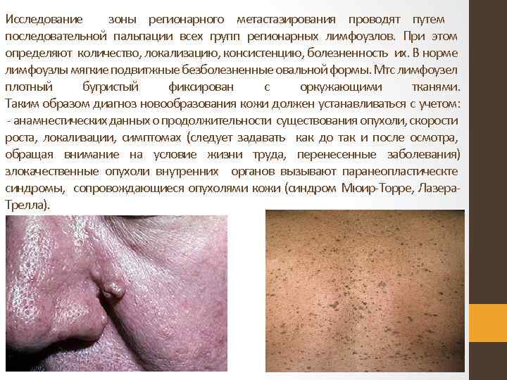 Исследование зоны регионарного метастазирования проводят путем последовательной пальпации всех групп регионарных лимфоузлов. При этом