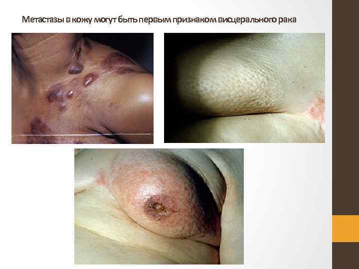 Метастазы в кожу могут быть первым признаком висцерального рака 