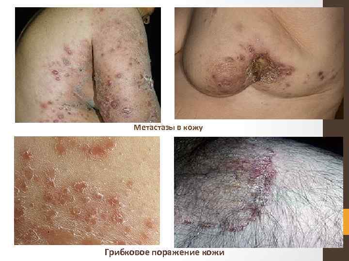 Метастазы в кожу Грибковое поражение кожи 