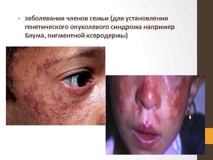 - заболевания членов семьи (для установления генетического опухолевого синдрома например Блума, пигментной ксеродермы) 