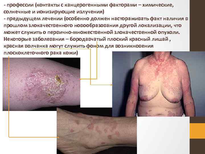  профессии (контакты с канцерогенными факторами – химические, солнечные и ионизирующие излучения) предыдущем лечении
