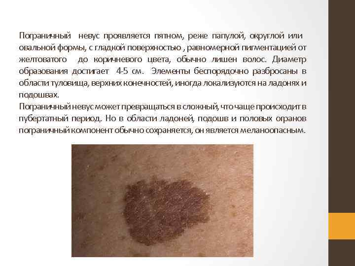 Пограничный невус проявляется пятном, реже папулой, округлой или овальной формы, с гладкой поверхностью ,