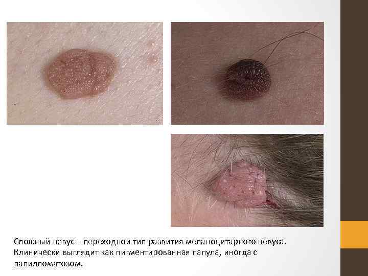 Сложный невус – переходной тип развития меланоцитарного невуса. Клинически выглядит как пигментированная папула, иногда