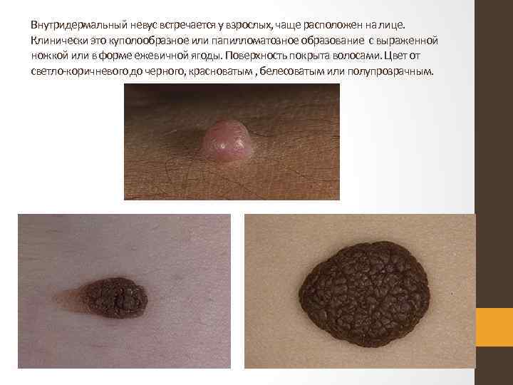 Внутридермальный невус встречается у взрослых, чаще расположен на лице. Клинически это куполообразное или папилломатозное