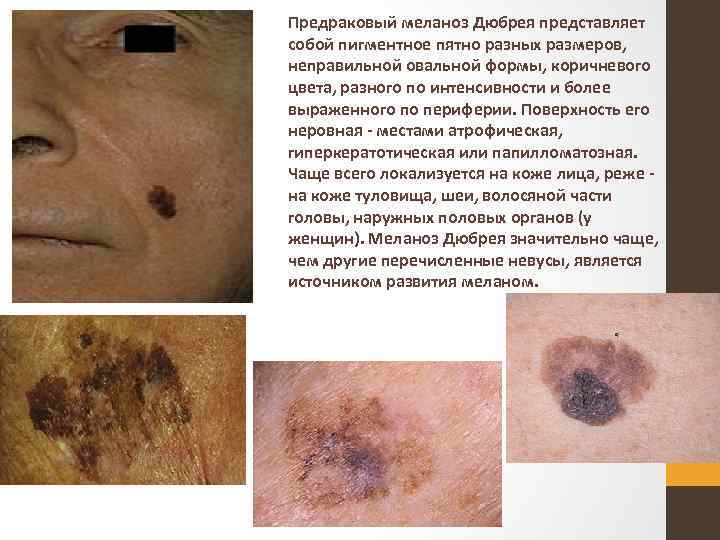 Предраковый меланоз Дюбрея представляет собой пигментное пятно разных размеров, неправильной овальной формы, коричневого цвета,