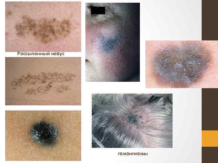 Рассыпанный невус гемангиомы 