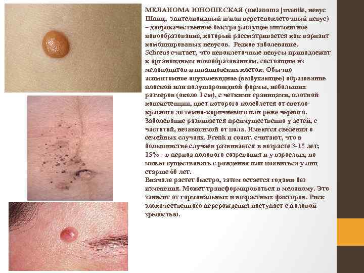 МЕЛАНОМА ЮНОШЕСКАЯ (melanoma juvenile, невус Шпиц, эпителиоидный и/или веретеноклеточный невус) – доброкачественное быстро растущее