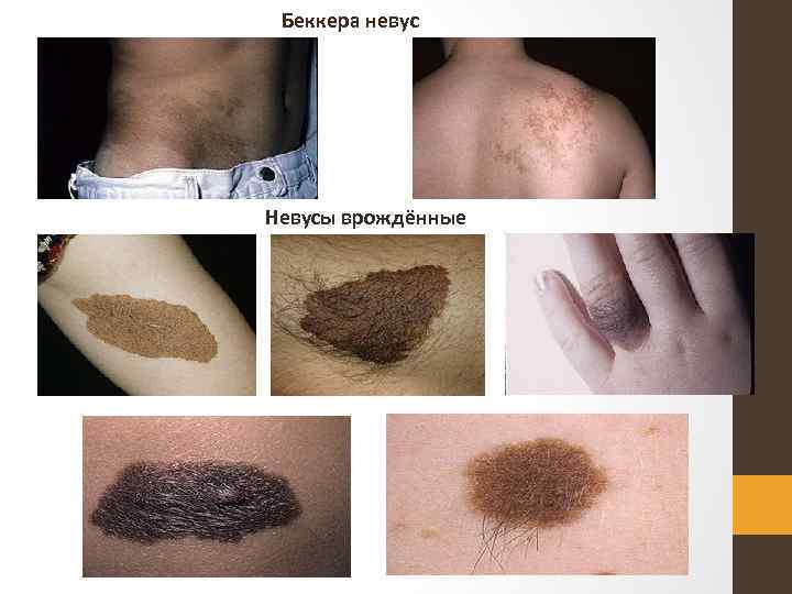 Беккера невус Невусы врождённые 