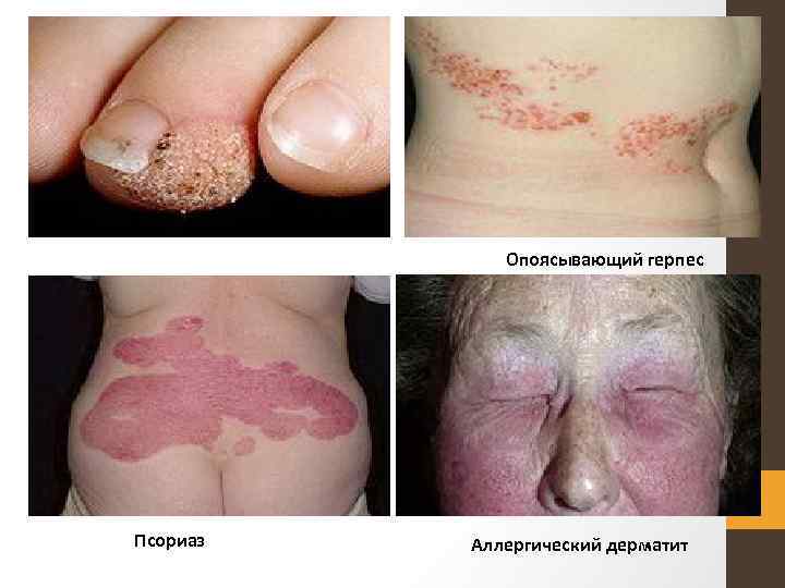 Опоясывающий герпес Псориаз Аллергический дерматит 
