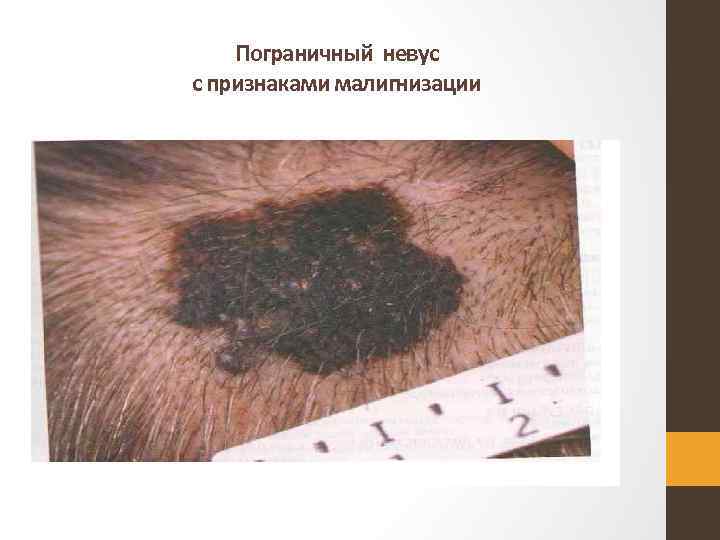 Пограничный невус с признаками малигнизации 