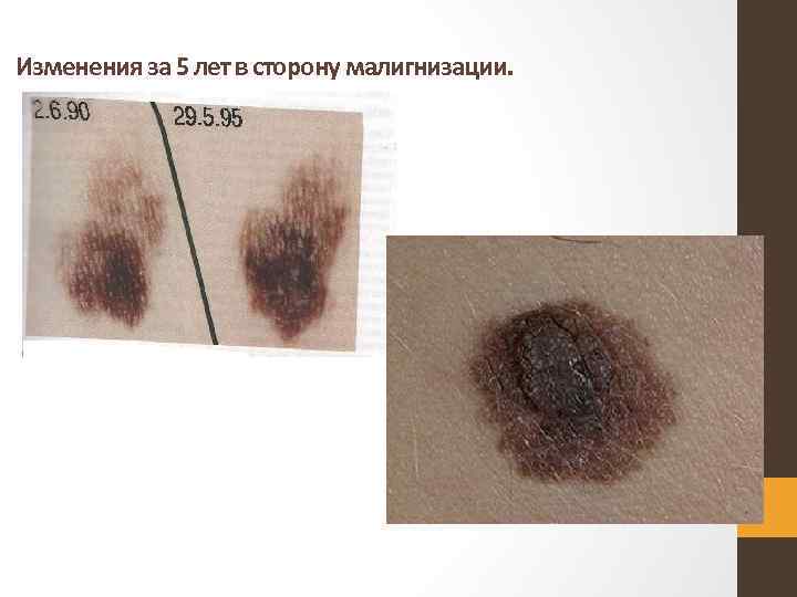 Изменения за 5 лет в сторону малигнизации. 