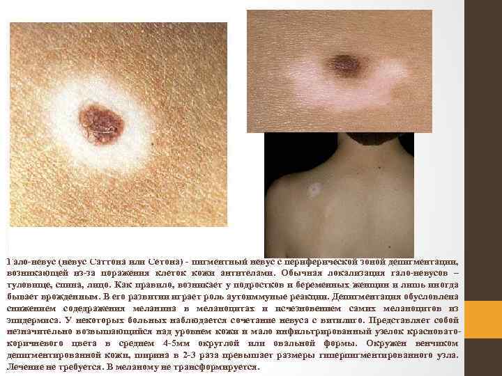 Гало-невус (невус Саттона или Сетона) - пигментный невус с периферической зоной депигментации, возникающей из-за