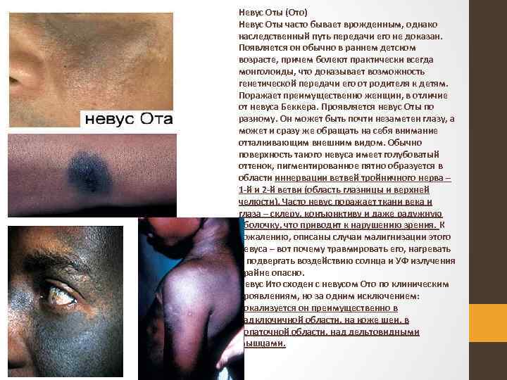 Невус Оты (Ото) Невус Оты часто бывает врожденным, однако наследственный путь передачи его не