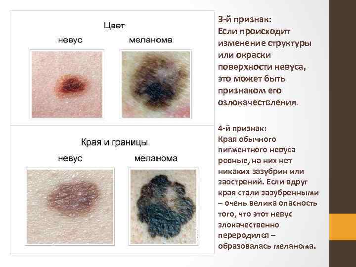 3 й признак: Если происходит изменение структуры или окраски поверхности невуса, это может быть